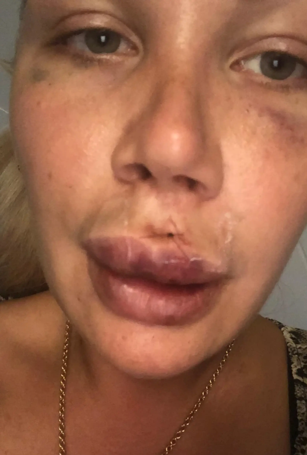 Lia Balanovská po útoku