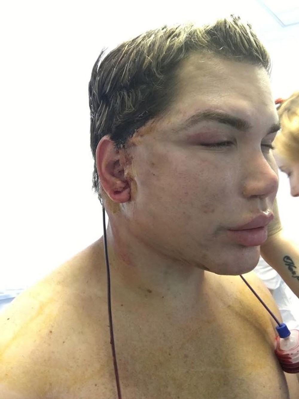 Rodrigo-Alves po plastike