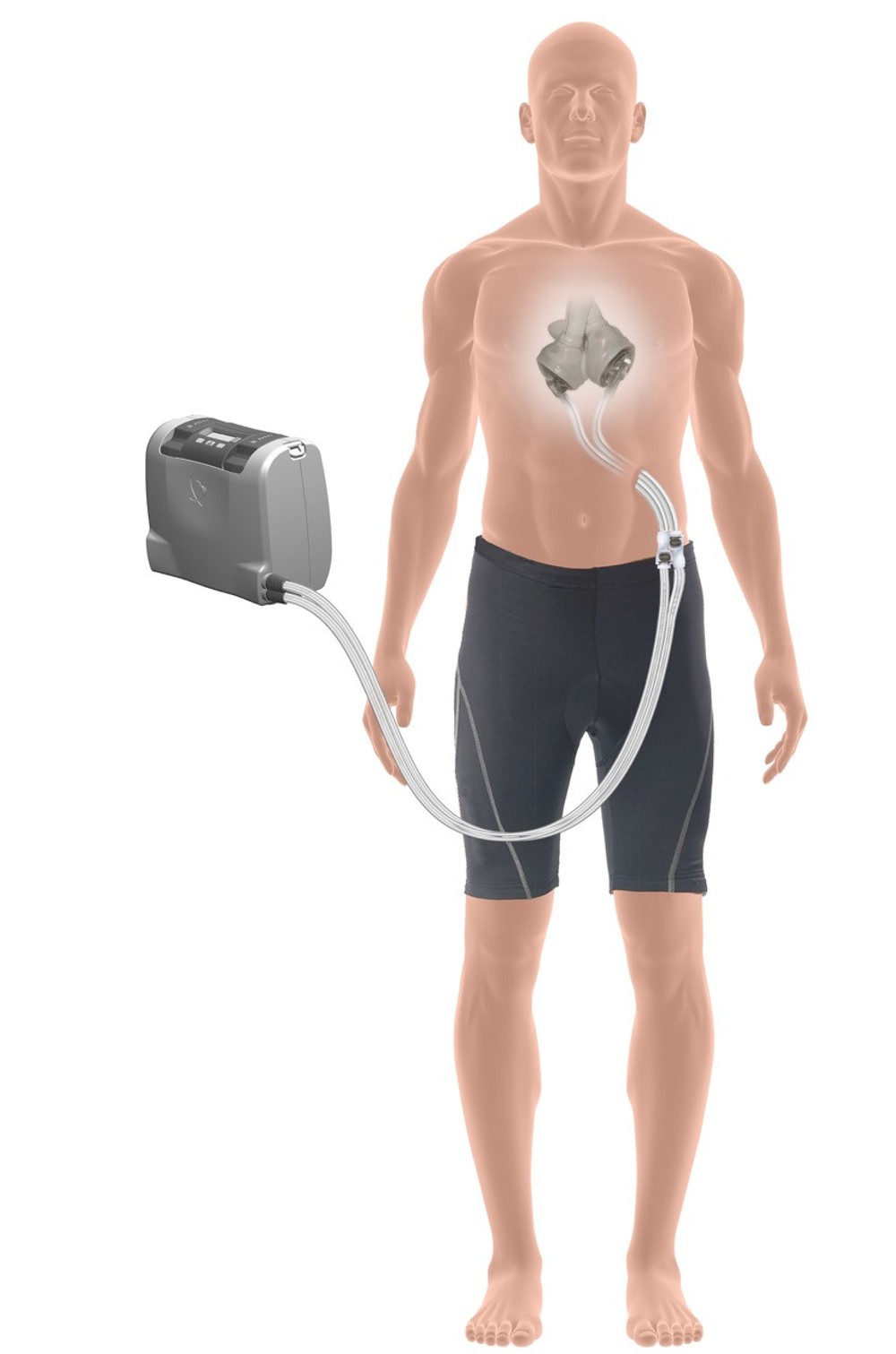 Prvý slovenský pacient s umelým srdcom je už aj po transplantácii srdca