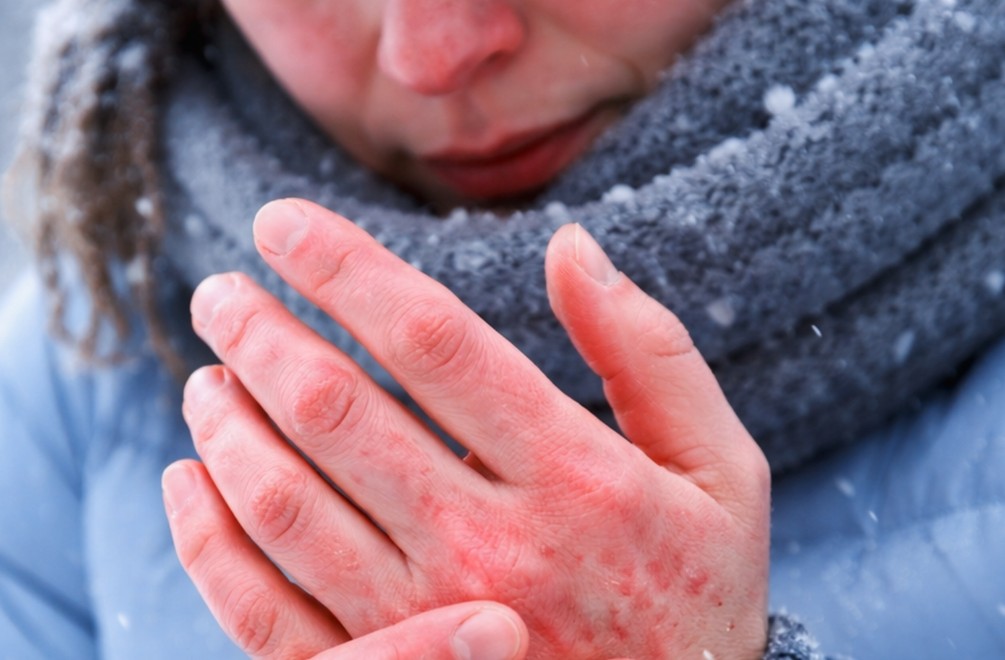 Trpíte v MRAZOCH viac než iní? 6 príznakov, že máte alergiu na chlad!