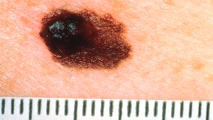 Farmafirmy oznámili  pokrok pri vývoji vakcíny proti rakovine kože