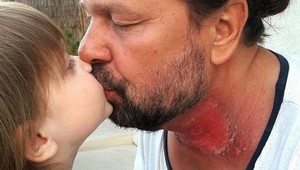 Pomeje má od ožarovania vypálený krk