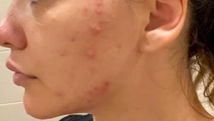 Pod nánosom mejkapu skrývala brutálne akné: Jojkárska herečka ukázala, s čím roky bojovala