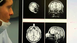 Vedci objavili novú zbraň v boji proti Alzheimerovej chorobe