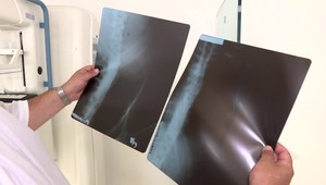 Spravia vám v týchto dňoch röntgen? Lekári, nemocnica aj ministerstvo na to majú rozdielny pohľad