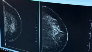 Ministerstvo zdravotníctva začne pozývať na skríning prsníkov. Ženy budú vyšetrovať len na preverených pracoviskách