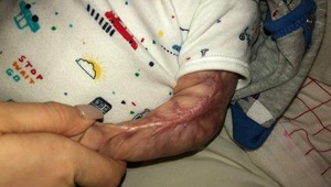 Predčasniatku, ktoré sa narodilo bez kože, nedávali šancu: Takto vyzerá teraz!