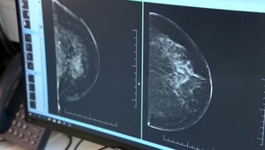 Nová štúdia naznačuje, že zmeškanie prvého mamogramu súvisí so zvýšeným rizikom úmrtia na rakovinu prsníka
