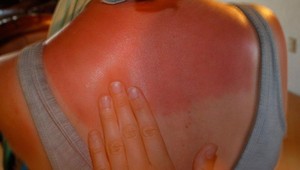 Jej zlepšovák valcuje facebook: Žena sa iba za 30 minút zbavila spálenej pokožky