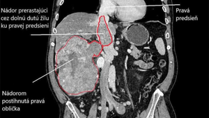 Nádor veľký ako rugbyová lopta: Náročný zákrok trval 7 hodín, skončil sa však úspešne