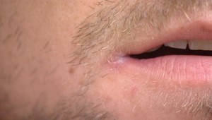 Trápia vás ranky v kútikoch úst? Sú prejavom oslabenej imunity