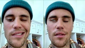 Justin Bieber ruší turné, OCHRNULA mu polovica tváre! Ide o zriedkavú poruchu!