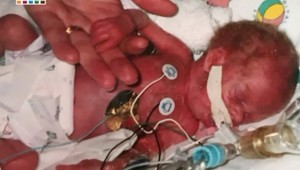 Predčasne narodenému chlapcovi nedávali šance: TOTO dokázal po 17-tich rokoch