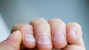 Muža takmer zabilo obhryzávanie nechtov