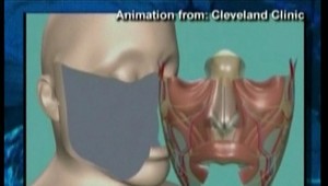 Transplantácia 80 percent tváre znetvorenej pacientky trvala 22 hodín