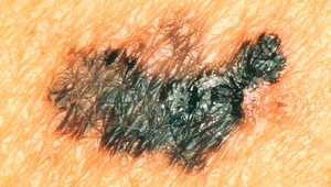 mRNA vakcína proti rakovine kože znižuje riziko recidívy alebo úmrtia na polovicu