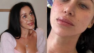 Bianka Rumanová opäť mení tvár: Fanúšikom ukázala zákrok, ktorý nie je pre SLABÉ povahy!