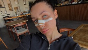 FOTO Bianka Rumanová je na nespoznanie! TAKTO vyzerá po operácii nosa