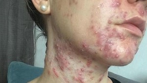 Žena sa hanbila odlíčiť aj vyzliecť: Lieky odmietla, TAKTO sa zbavila ťažkého akné