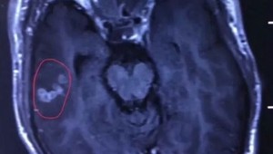 Trápili ho silné bolesti hlavy a epileptické záchvaty. Lekári mu na mozgu našli živú pásomnicu