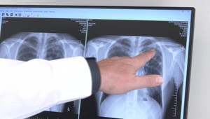 Tuberkulóza na vzostupe: Alarmujúce čísla prichádzajú z podtatranského regiónu