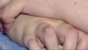 Ako zvládnuť vzplanutie reumy: Záleží na životospráve aj duševnej pohode