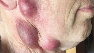 Na tvári mal odrazu obrovské vredy. Keby nešiel k lekárovi, mohol zomrieť