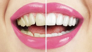 10 prírodných metód, ktoré fungujú: Získajte biely a žiarivý úsmev!