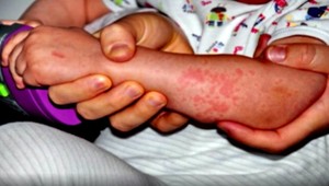 Osýpok v Michalovciach pribúda. Nakazených je už 13 ľudí