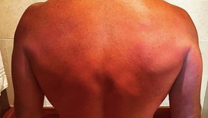 Hollywoodsky herec to prehnal s opaľovaním. TOTO bude pekelne bolieť!