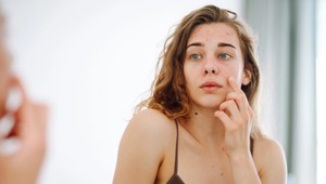 Čo prezradí akné na vašej tvári? Zlé trávenie, alergie aj hormonálne zmeny