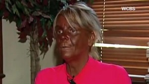 Roky chodila do solárka takmer každý deň: Pozrite sa, ako ju zmenilo nadmerné opaľovanie