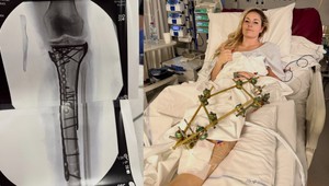 Hrozila mi amputácia, potvrdila Lindsey VONN