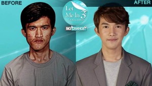 Zmena, ktorá vyrazila dych! Mladíka po plastickej operácii nespoznala ani vlastná matka!