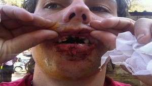 Video iba pre silné žalúdky: na ihrisku nechal zuby!