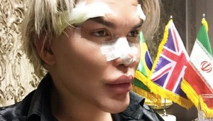 Živý Ken absolvoval desiatu operáciu nosa. Odpadne mu?