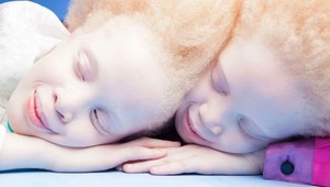 Spomínate si na tieto nezvyčajné dvojčatá? TAKTO vyzerajú žiadané modelky dnes