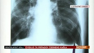 Keď rastie nádor pľúc, objavuje sa okrem kašľa aj iných 9 nečakaných príznakov. Onkologička ich popísala