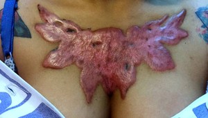 FOTOGALÉRIA: Mladej žene odpadlo po zákroku tetovanie aj s kožou