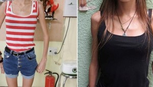 Takmer sa vyhladovala na smrť: Takto vyzerá žena, ktorá vážila 33 kíl!