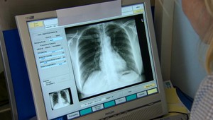 7 príznakov pľúcnej embólie: Čo vás môže varovať?