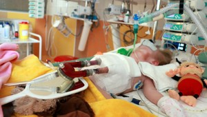Dieťa čakalo na transplantáciu, pri živote ho držalo mechanické srdce