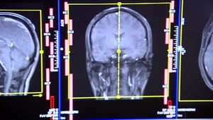 Naši neurochirurgovia operujú mozog pri vedomí. Pred 15 rokmi to bolo inak