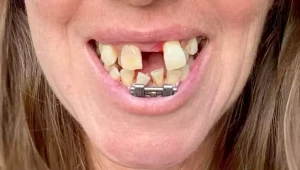 Kvôli krivým zubom vyzerala ako žralok: Operácia a nový chrup ženu zmenili na nepoznanie