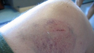 Prečo sa vám ľahko tvoria modriny? Problémom môže byť opaľovanie, málo vitamínov, či dedičnosť