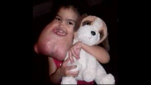 Dievčatko malo na tvári obrovský nádor, v rodnej krajine jej pomôcť nedokázali