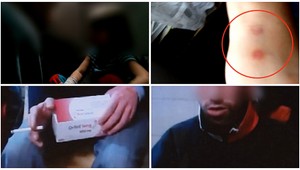 Žiadny hmyz. Popáleniny na rukách Jarky (7) nie sú vylúčené, tvrdí nová správa