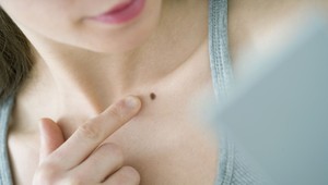 Bojíte sa rokoviny kože: Väčšina nádorov zo znamienok sa zistí včas, uviedla dermatologička