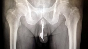 FOTO. Dôchodcovi našli v penise 10-centimetrovú vidličku!