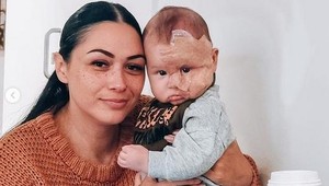 Narodil sa so znamienkom cez polovicu tváre: Matka mu chcela pomôcť, ľudia ju nazvali monštrom